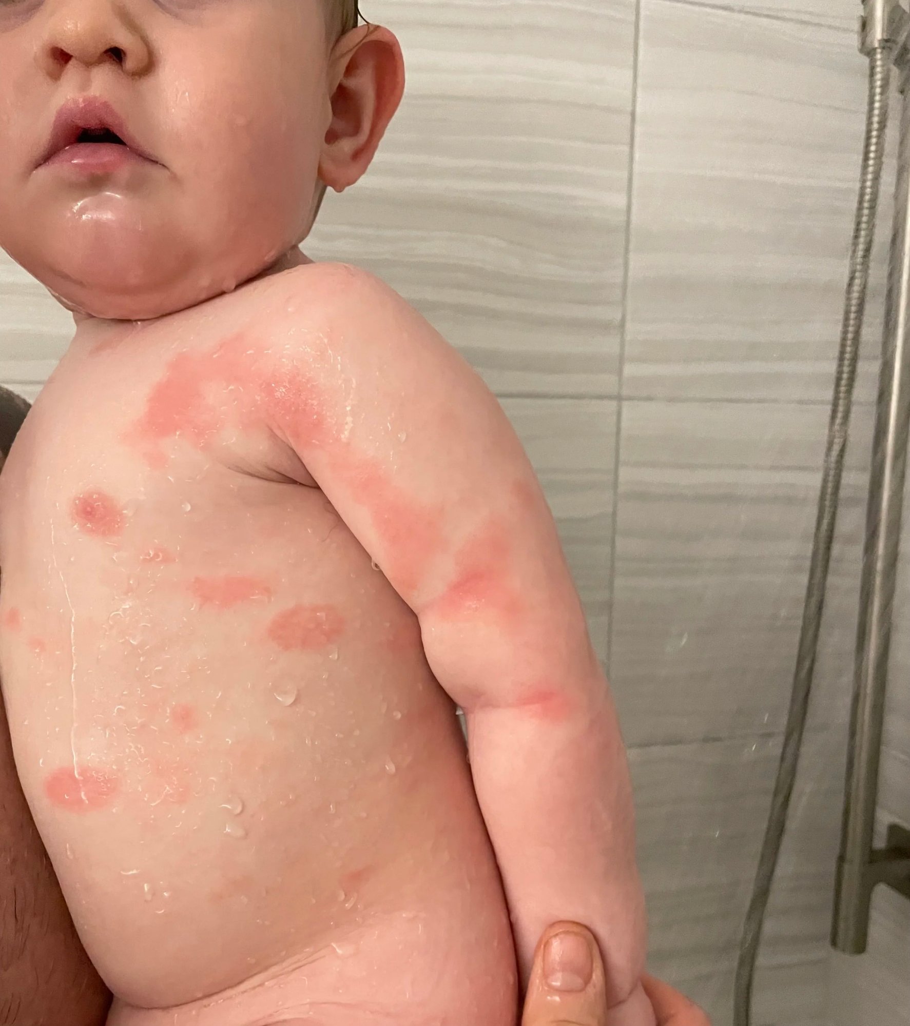 Baby with eczema rash on body and arms being held during bath