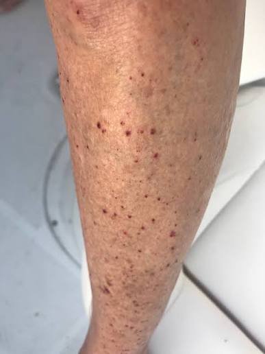 Close-up of an older person's lower leg showing dry skin with scattered small red spots and fine cracks typical of asteatotic eczema.